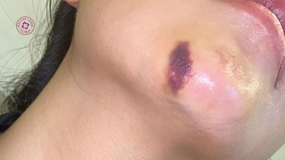 phản ứng bầm tím sau tiêm prp