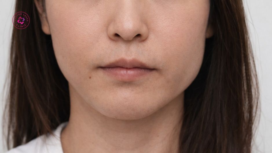 phình cơ cắn sau tiêm botox