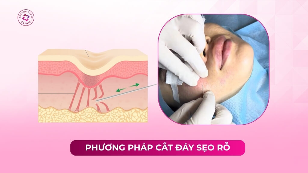 phương pháp cắt đáy sẹo rỗ
