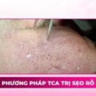 Chấm TCA trị sẹo rỗ: Ưu điểm, quy trình và thời gian hồi phục