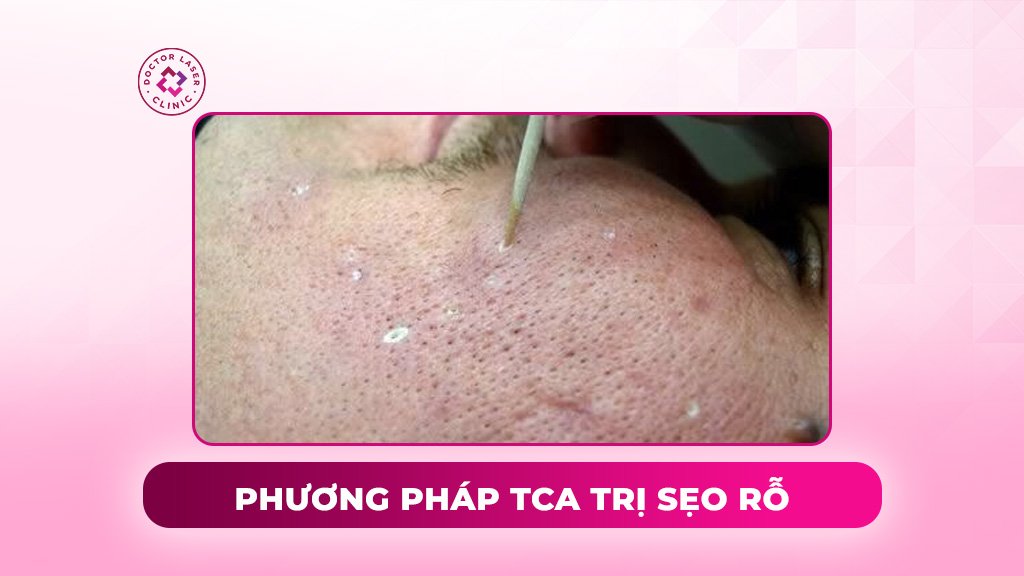 phương pháp tca trị sẹo rỗ