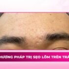 9 phương pháp trị sẹo lõm trên trán hiệu quả giúp làn da mịn màng