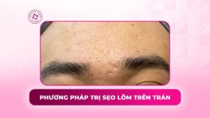 phương pháp trị sẹo lõm trên trán phương pháp trị sẹo lõm trên trán