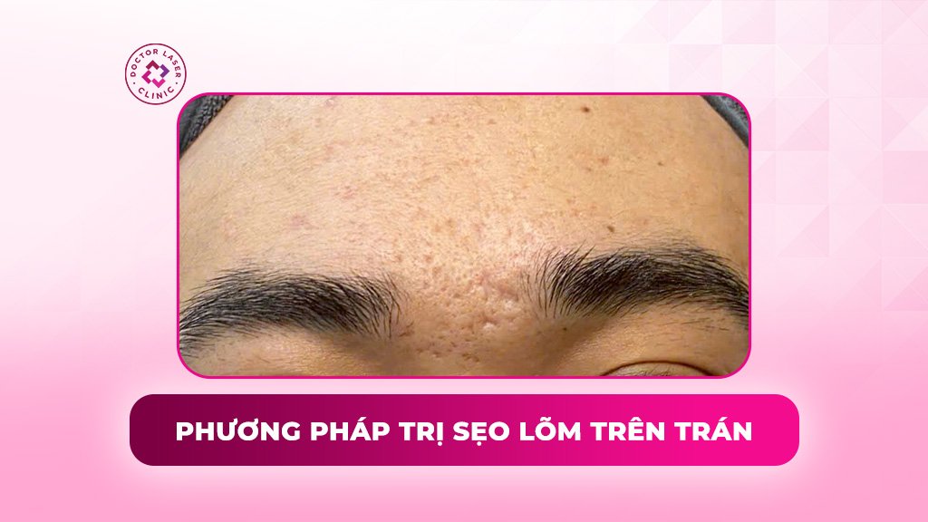 9 phương pháp trị sẹo lõm trên trán hiệu quả giúp làn da mịn màng