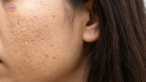 prp có hiệu quả với da lão hóa hay sẹo rỗ đến mức nào