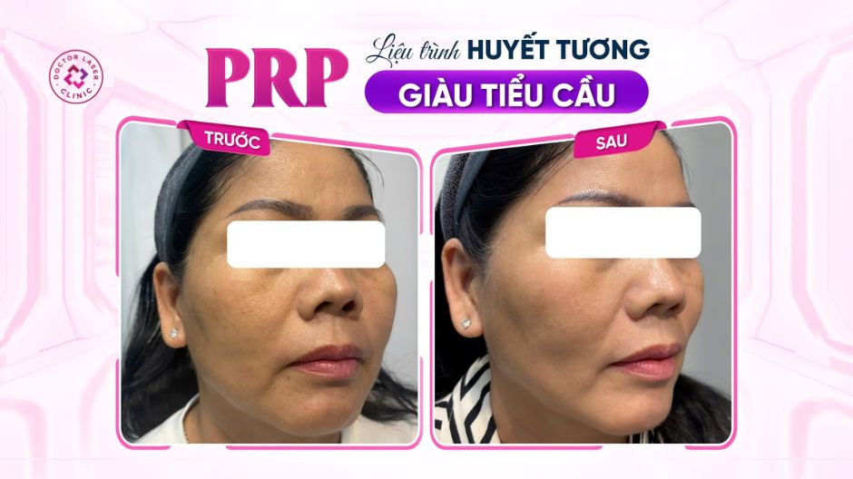 prp meso trước và sau điều trị