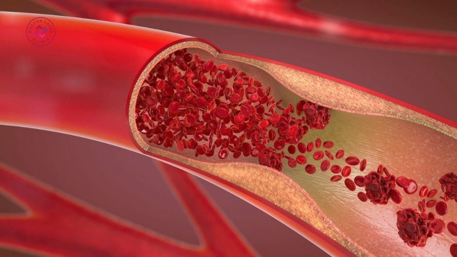 prp trị sẹo rỗ chống chỉ định rối loạn đông máu
