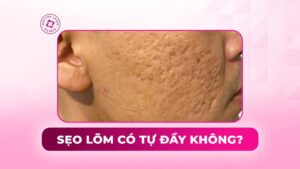 sẹo lõm có tự đầy không sẹo lõm có tự đầy không