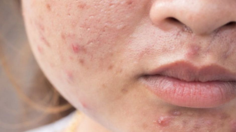 sẹo lõm do mụn bọc mụn nang