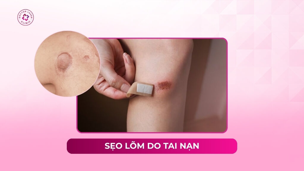 Sẹo lõm do tai nạn có tự lành được không? Các phương pháp điều trị