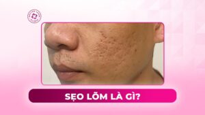sẹo lõm là gì sẹo lõm là gì