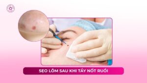sẹo lõm sau khi tẩy nốt ruồi sẹo lõm sau khi tẩy nốt ruồi