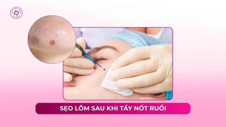 VẾT THÂM SAU TẨY NỐT RUỒI CÓ THỂ MỜ THEO THỜI GIAN