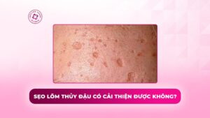 sẹo lõm thủy đậu có cải thiện được không sẹo lõm thủy đậu có cải thiện được không