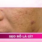 Sẹo rỗ là gì? Nguyên nhân, dấu hiệu và cách phòng ngừa