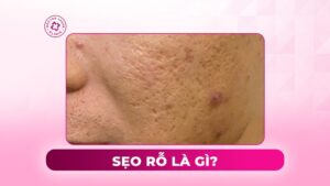 sẹo rỗ là gì
