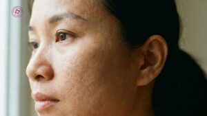 sẹo rỗ lâu năm có phải sống chung suốt đời