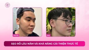 sẹo rỗ lâu năm và khả năng cải thiện thực tế