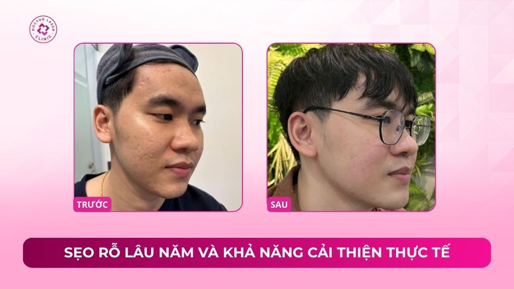 Sẹo rỗ lâu năm và khả năng cải thiện thực tế