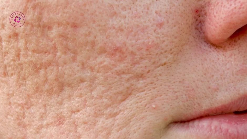 sẹo rỗ lõm sâu khiến bề mặt da không đồng đều