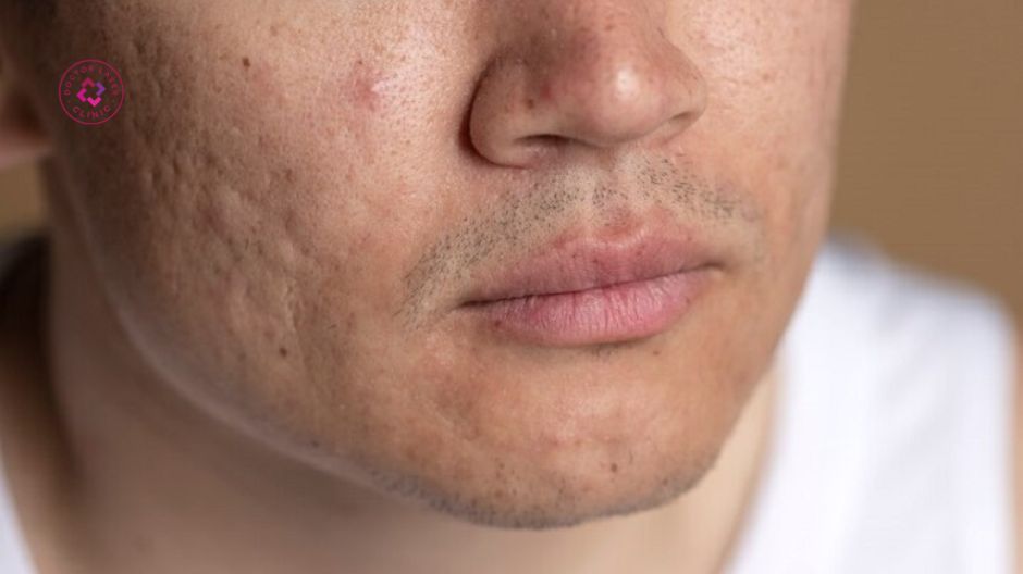 sẹo rỗ nặng lõm sâu trên gương mặt