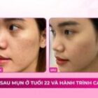 Sẹo rỗ sau mụn ở tuổi 22 và hành trình cải thiện làn da
