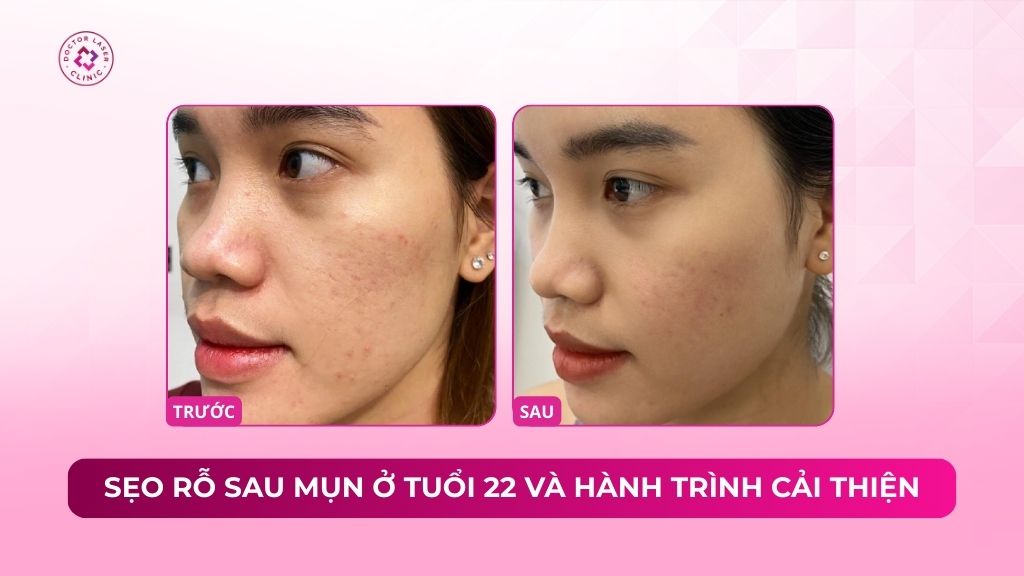 sẹo rỗ sau mụn ở tuổi 22 và hành trình cải thiện