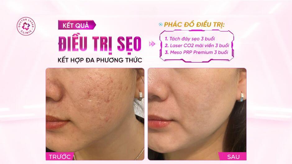 sẹo rỗ vùng má sau liệu trình điều trị