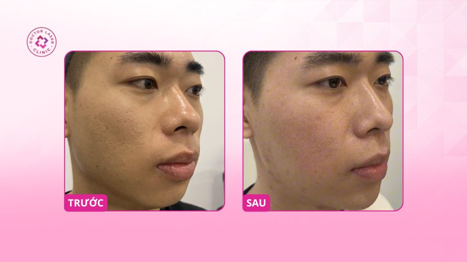 so sánh trước sau điều trị sẹo lõm bằng laser co2