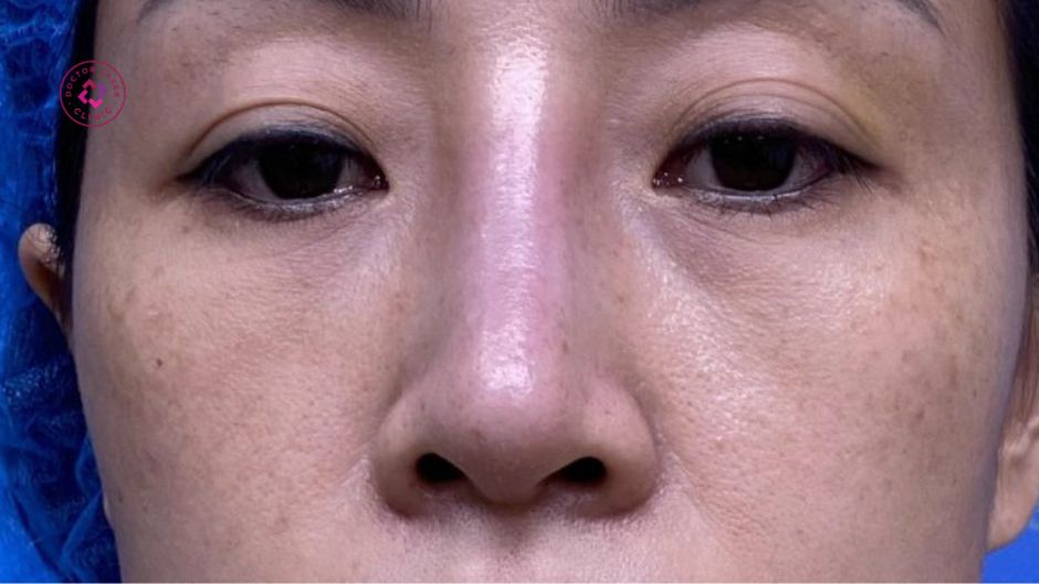 sưng bầm sau căng chỉ nâng mũi