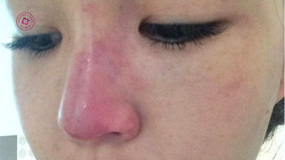 sưng phù bất thường sau tiêm filler mũi