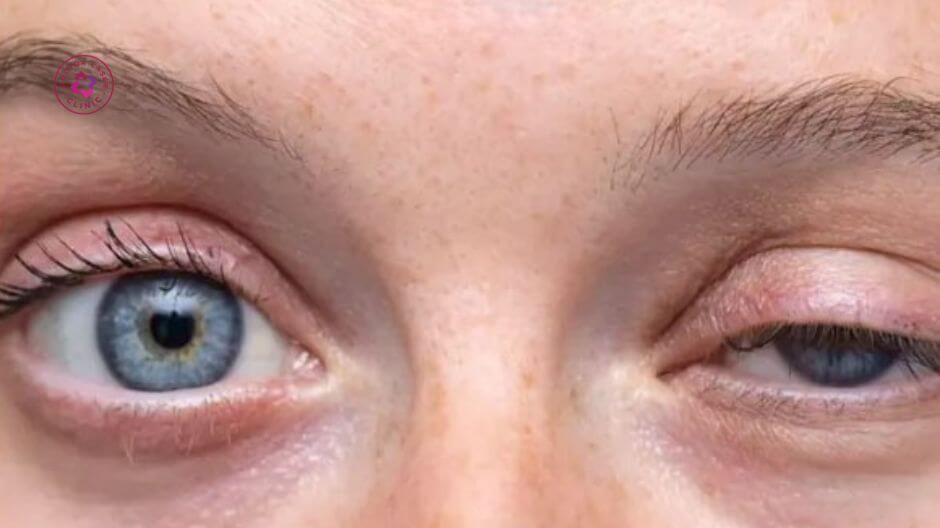 sụp mí nhẹ sau tiêm botox là tác dụng phụ tạm thời có thể gặp