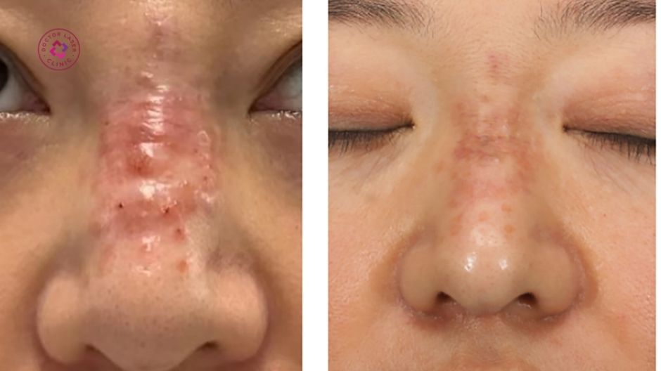 tắc mạch sau tiêm filler mũi