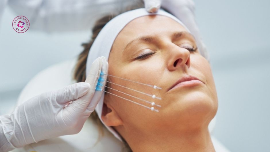 tay nghề bác sĩ ảnh hưởng đến hiệu quả căng chỉ rãnh cười