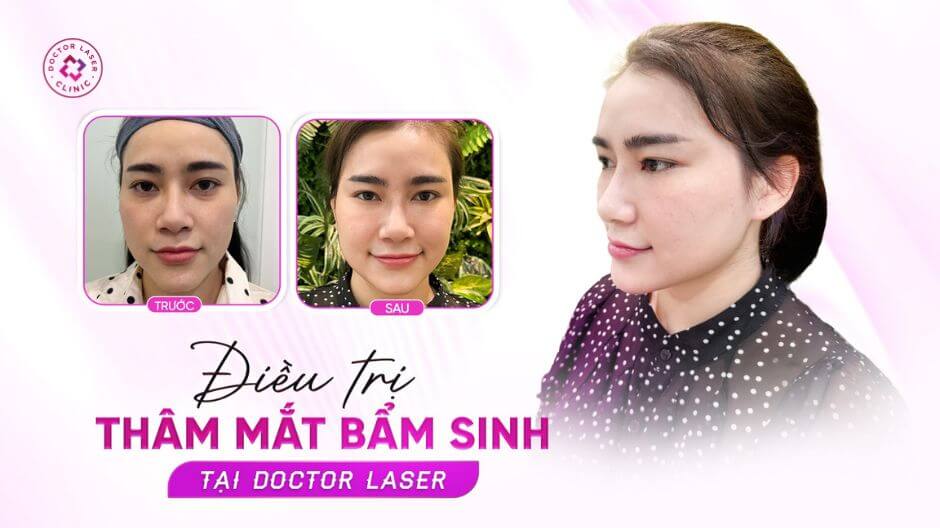 thâm mắt cơ địa trước sau tiêm filler