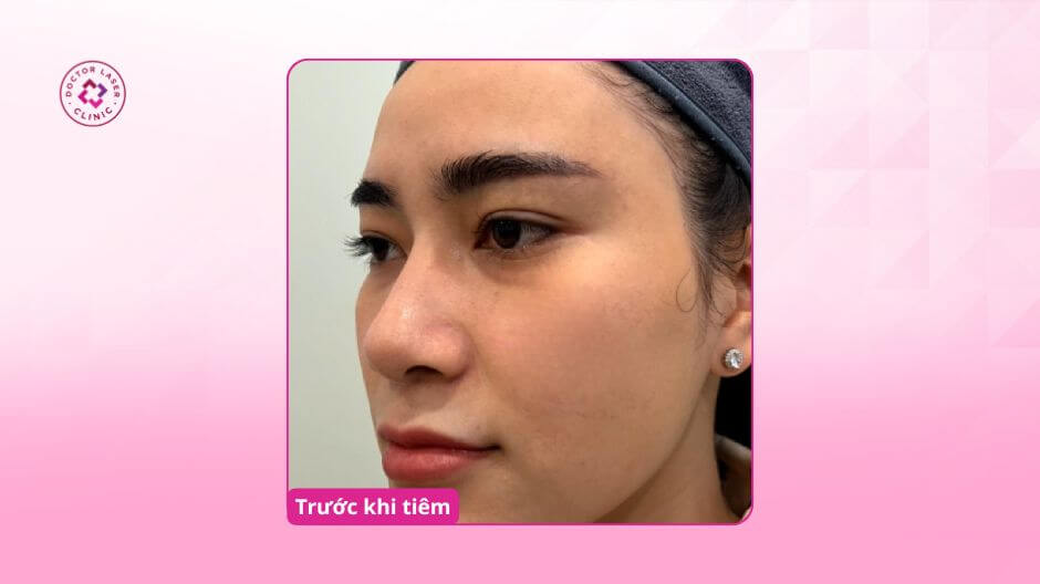 thâm mắt cơ địa trước khi tiêm filler