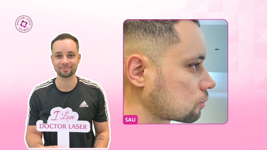 thiago kết quả điều trị sẹo rỗ lâu năm