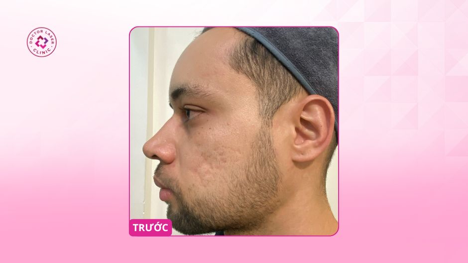 thiago sẹo rỗ lâu năm trước khi điều trị