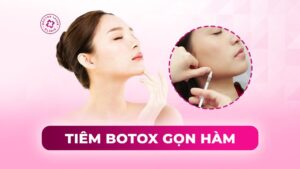 tiêm botox gọn hàm
