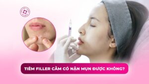 tiêm filler cằm có nặn mụn được không