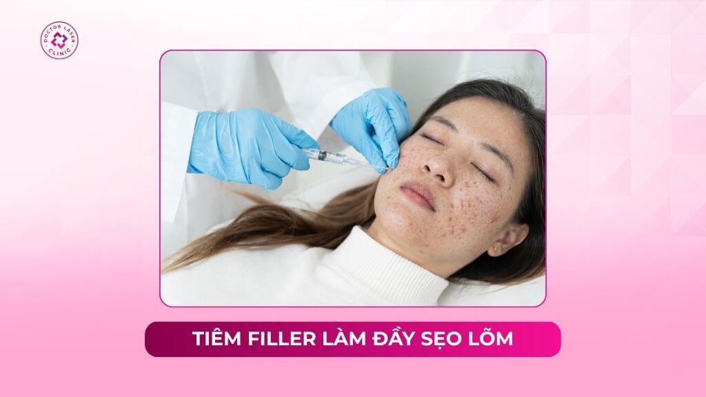 Tiêm filler làm đầy sẹo lõm có hiệu quả không?