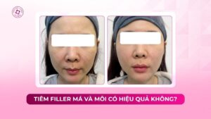 tiêm filler má và môi hiệu quả không
