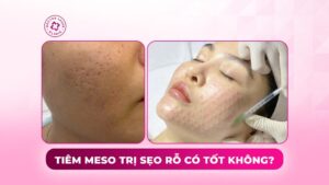 tiêm meso trị sẹo rỗ có tốt không tiêm meso trị sẹo rỗ có tốt không