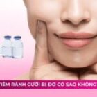 Tiêm rãnh cười bị đơ có sao không? Nguyên nhân và cách khắc phục
