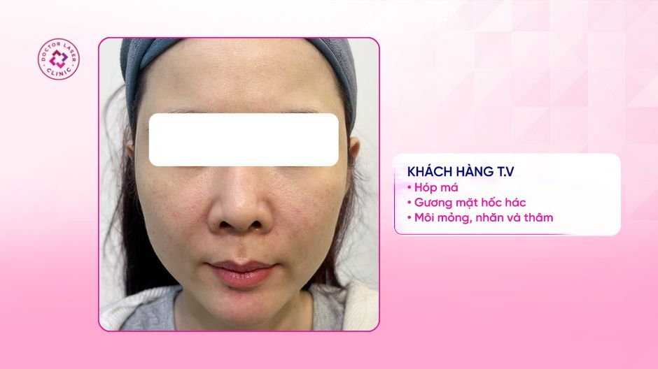 tình trạng má hóp môi mỏng trước điều trị