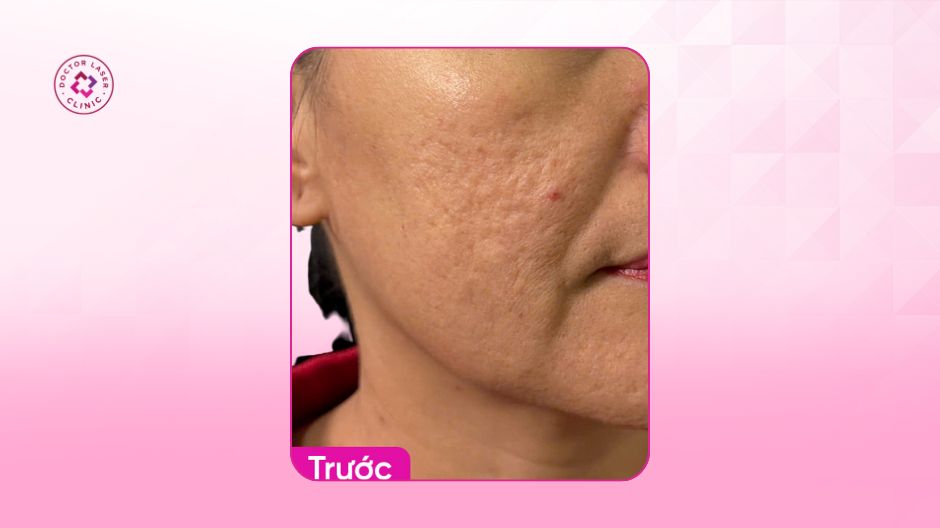 tình trạng sẹo rỗ vùng má