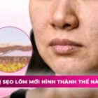 Trị sẹo lõm mới hình thành thế nào để đạt được hiệu quả tốt?