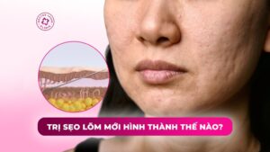 trị sẹo lõm mới hình thành thế nào trị sẹo lõm mới hình thành thế nào