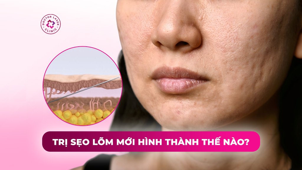 Trị sẹo lõm mới hình thành thế nào để đạt được hiệu quả tốt?