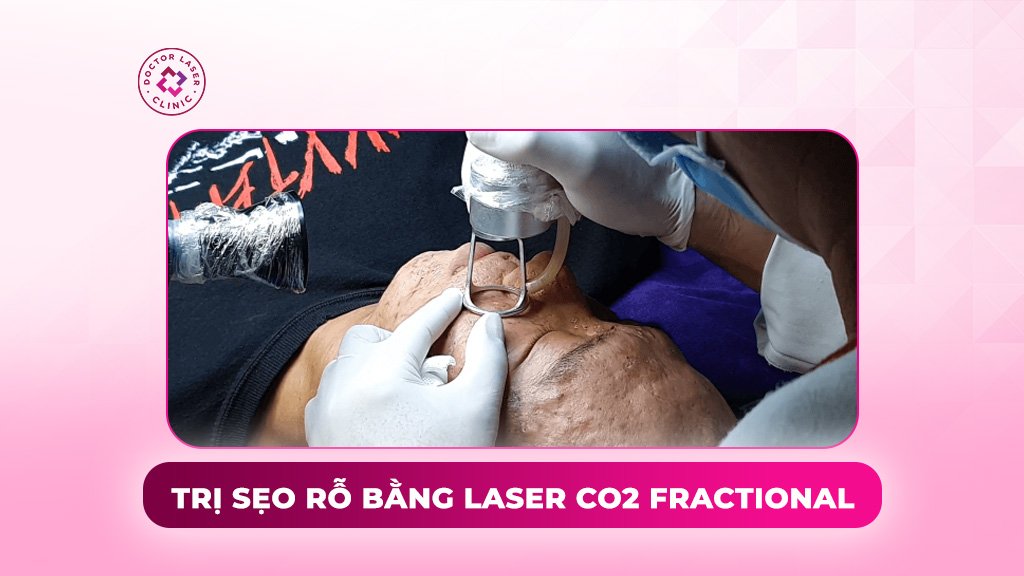 trị sẹo rỗ bằng laser co2 fractional